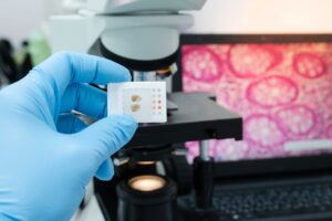 Scientist wear blue glove holding parafin human tissue block and out of focus microscope and computer monitor show glandular image